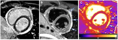 Novel role of cardiovascular MRI to contextualise tuberculous pericardial inflammation and oedema as predictors of constrictive pericarditis